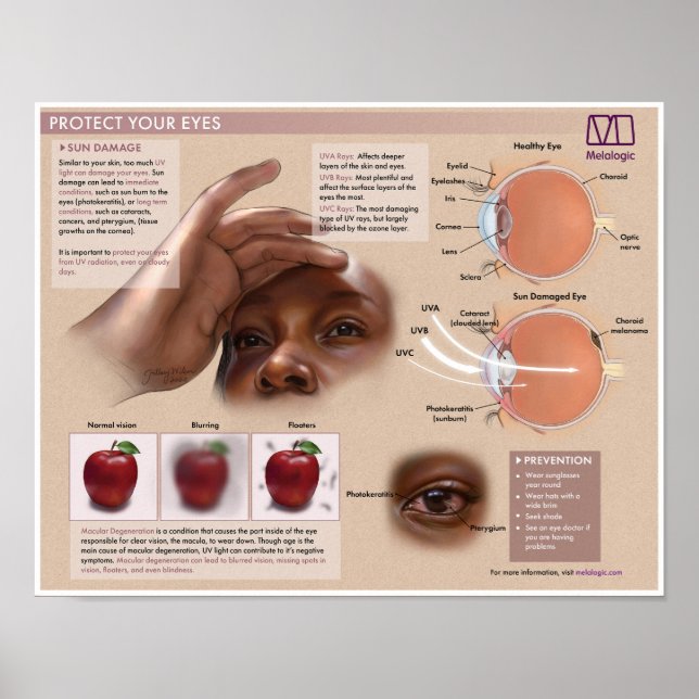 Poster Médicale de protection des yeux de mélalogi (Devant)