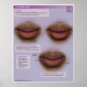 Poster Médicale des lèvres à lèvres changées de la