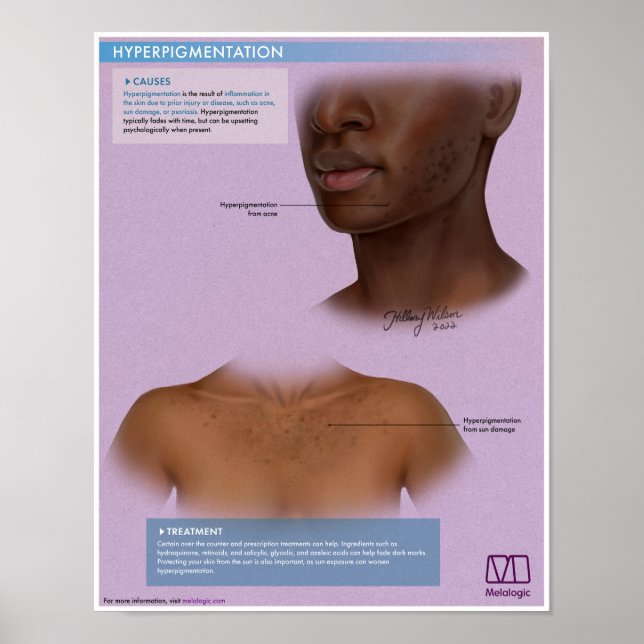 Poster Médicale d'Hyperpigmentation Melalogique (Devant)