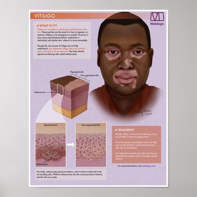 Poster Médicale Melalogo Vitiligo (Devant)