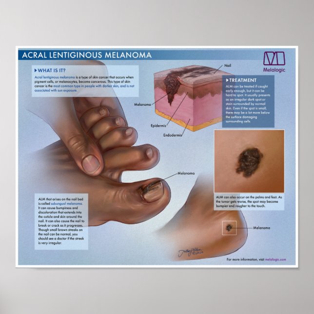 Poster Mélanoma Médicale Melalogique Acral (Devant)