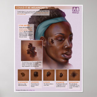 Poster Melanoma Melaloga Médicale