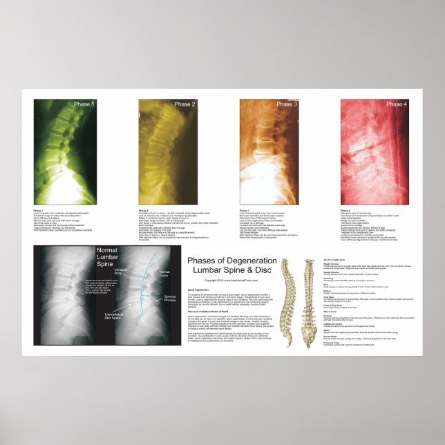 Poster Phases Lombaire Dégénération de la colonne vertébr (Devant)