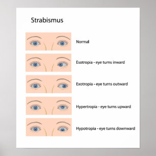 Poster pour défaut oculaire Strabismus