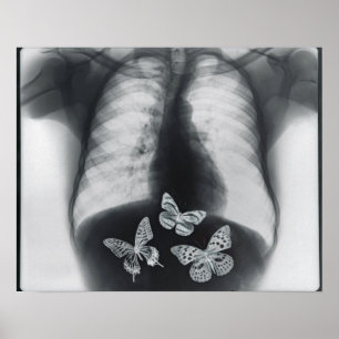 Poster rayons X de papillons dans l'estomac