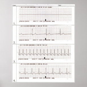 Poster rythmes ekg
