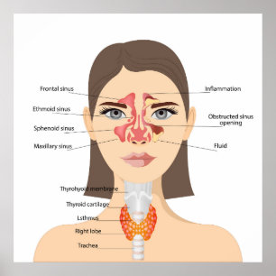 Poster Sinusitis