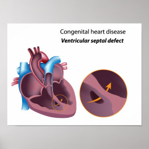 Poster sur les maladies cardiaques congénitales
