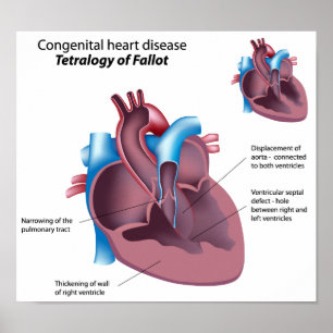 Poster sur les maladies cardiaques congénitales