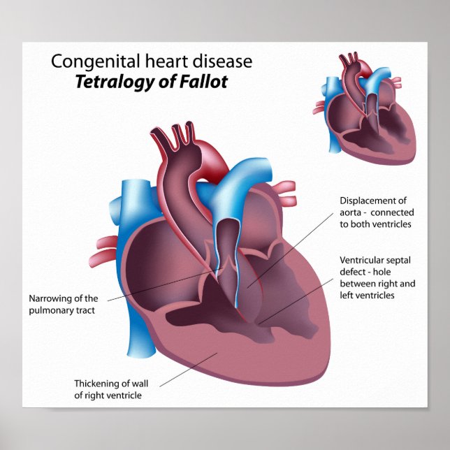 Poster sur les maladies cardiaques congénitales (Devant)