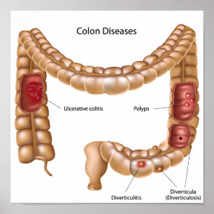 Poster sur les pathologies du côon