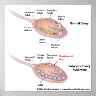 Poster Syndrome de l'ovaire polykystique, diagramme étiqu