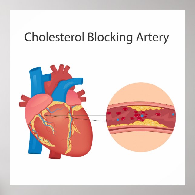 Poster Vaisseaux sanguins étroits (Devant)