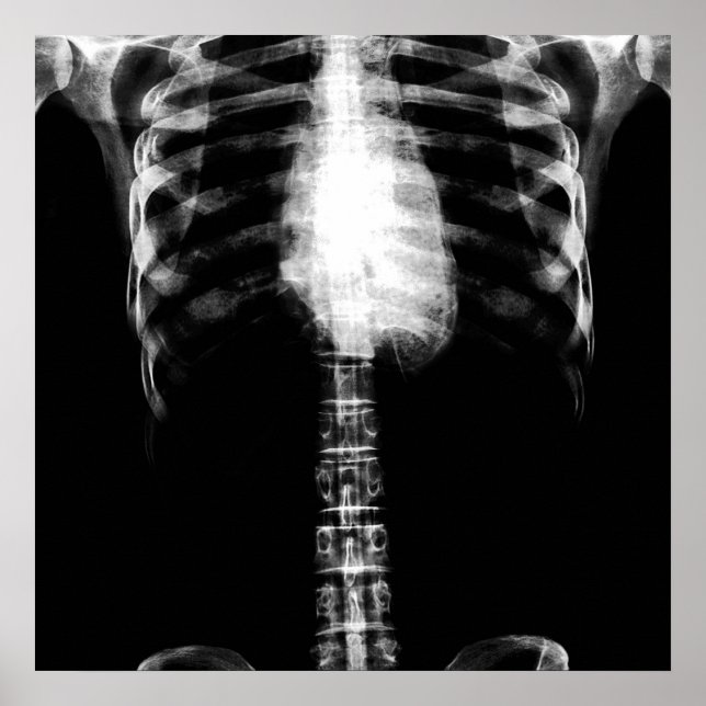 POSTER X-RAY SKELETON TORSO RIBS - B&W (Devant)
