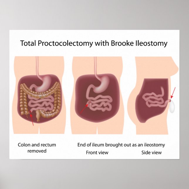 Proktoktomie insgesamt mit Brooke-Ileostomy-Poster Poster (Vorne)