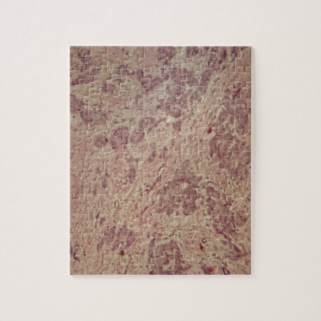Puzzle Cancer du sein sous le microscope (Vertical)
