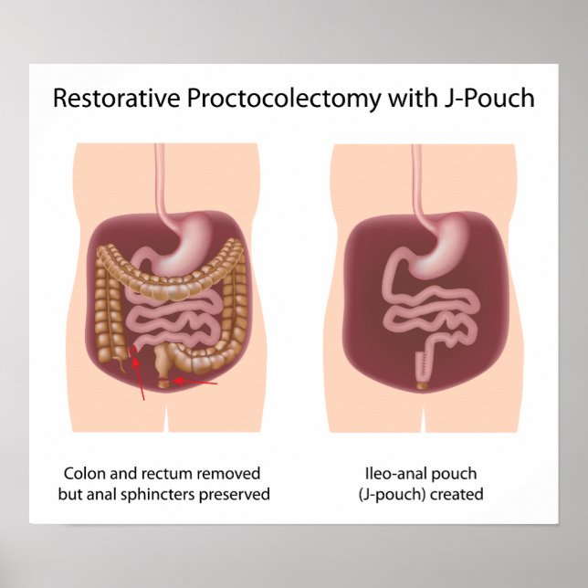 Restorative Proktoktomie-Operation mit j-pouch Poster (Vorne)