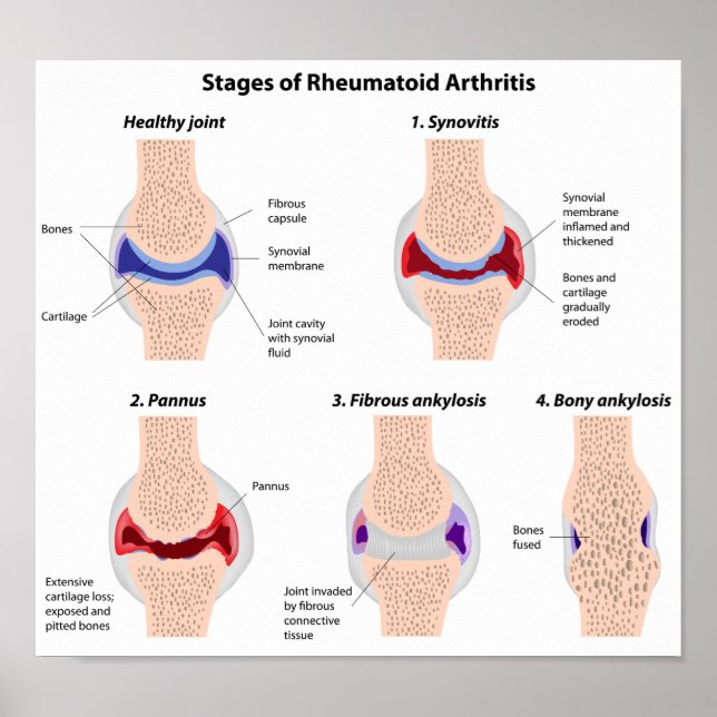 Rheumatoide Arthritis Poster (Vorne)