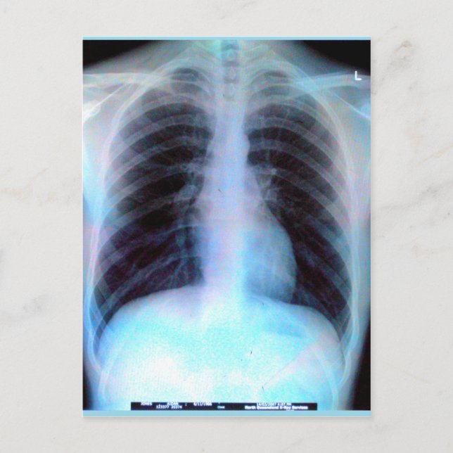 Ribcage Xray Skeleton Postkarte (Vorderseite)