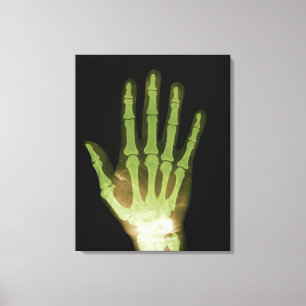 Röntgenstrahl der menschlichen Hand Leinwanddruck