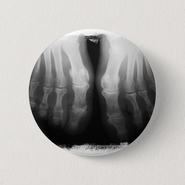 Röntgenstrahl-Fuß-menschliches Skeleton Button (Vorderseite)
