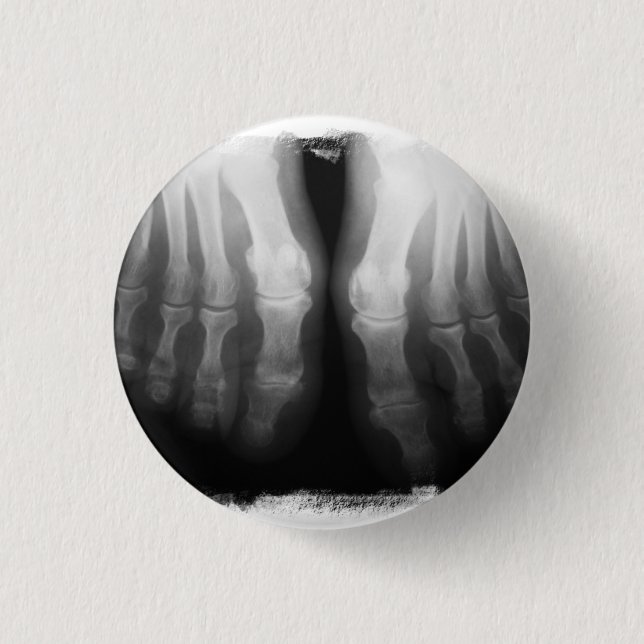 Röntgenstrahl-Fuß-menschliches Skeleton Button (Vorderseite)