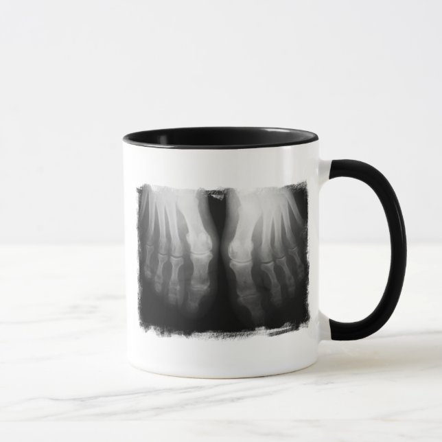 Röntgenstrahl-Fuß-menschliches Skeleton Tasse (Rechts)