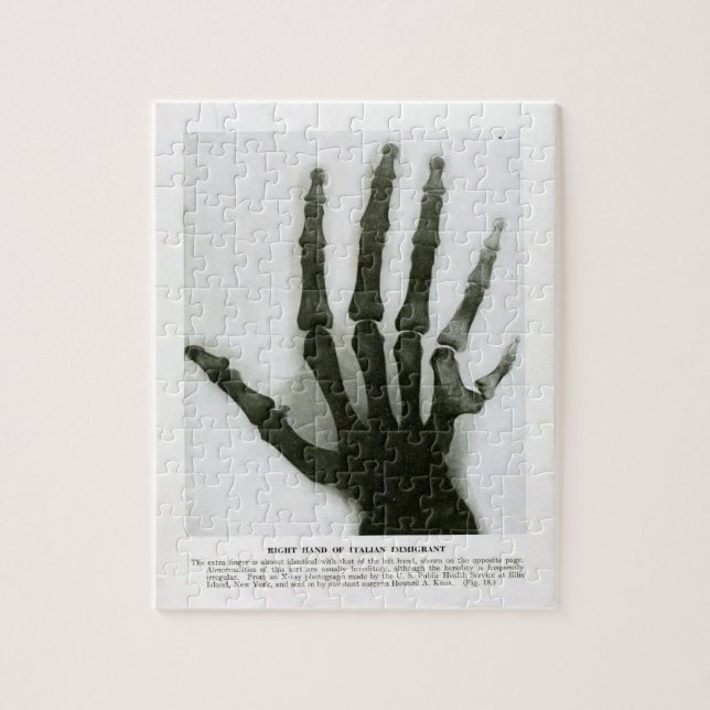 Röntgenstrahl von sechs fingrigem Handpuzzlespiel (Vertikal)