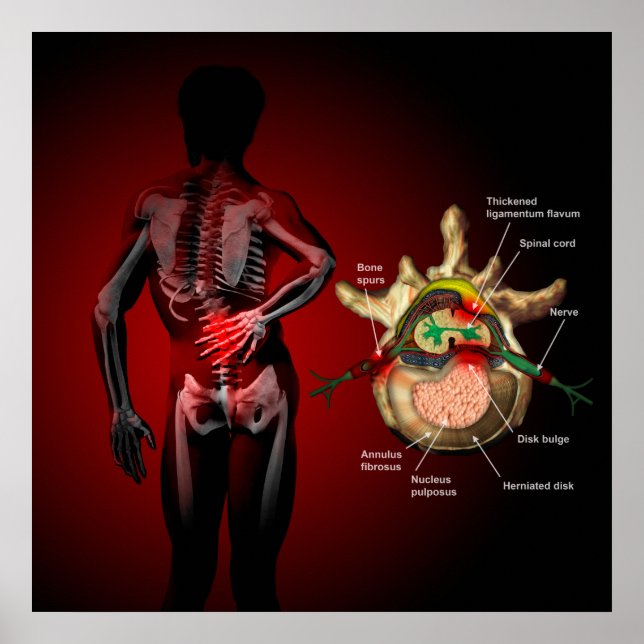 Rückenschmerzen Poster (Vorne)