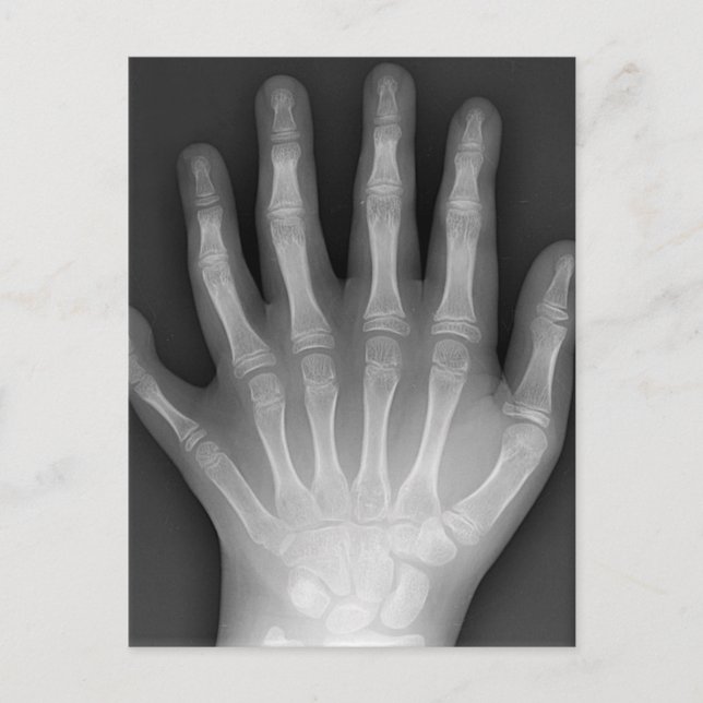 Sechs fingrige Hand, medizinische Rarität, Postkarte (Vorderseite)