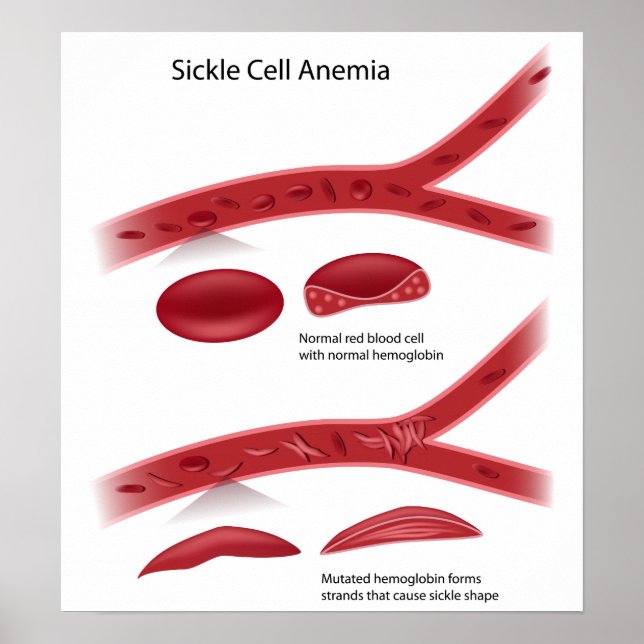 Sickle cell disease Poster (Vorne)