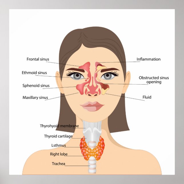 Sinusitis Poster (Vorne)