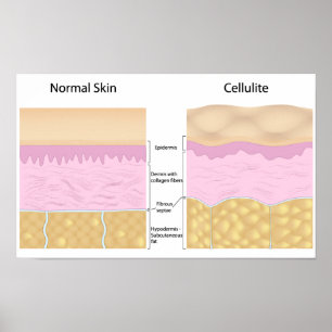 Skin Cellulite Poster