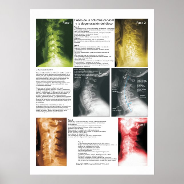Spanische Phasen Zervikalspinale Entkernung Poster (Vorne)