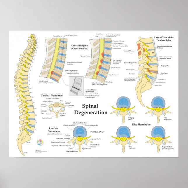 Spinal Degeneration Disk Herniation Poster (Vorne)
