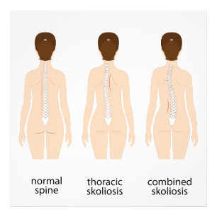 Spinalfehler Fotodruck