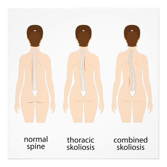 Spinalfehler Fotodruck (Vorne)