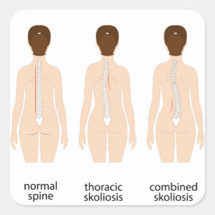 Spinalfehler Quadratischer Aufkleber