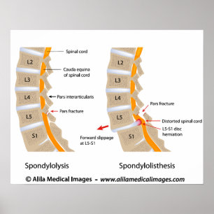 Spondylolysis und Wirbelgleiten, beschriftet Poster