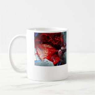 Steigende Aortenzerlegung Kaffeetasse
