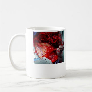 Steigende Aortenzerlegung Kaffeetasse