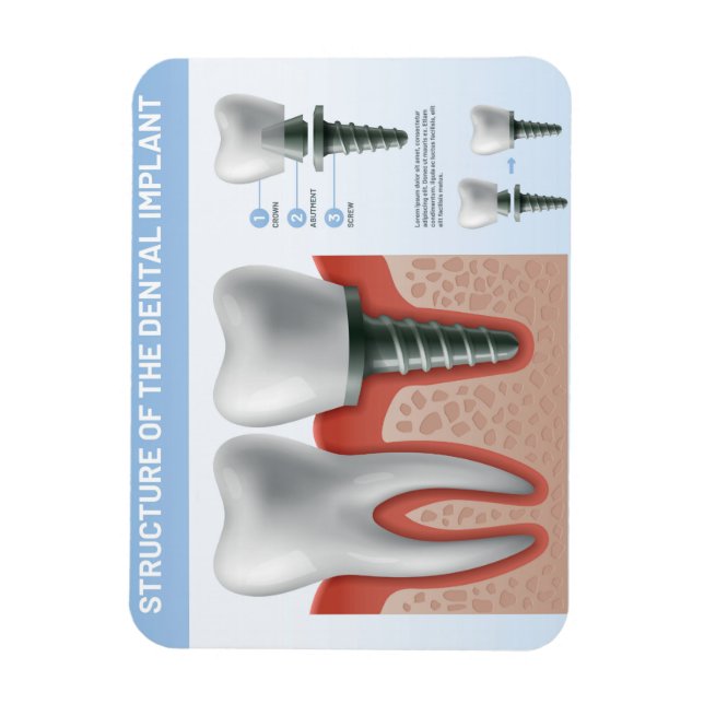 Struktur des Zahnimplantats Magnet (Vertikal)