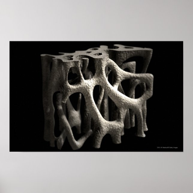 Struktur eines Knochens mit Osteoporose Poster (Vorne)