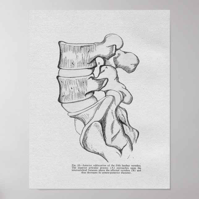 Subluxe Vertébrale Chiropratique Impression Vintag (Devant)