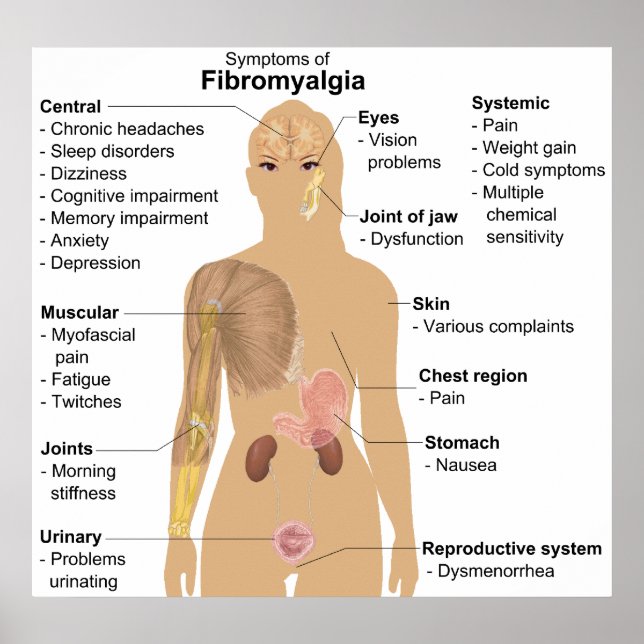 Symptomatik der Fibromyalgie Poster (Vorne)