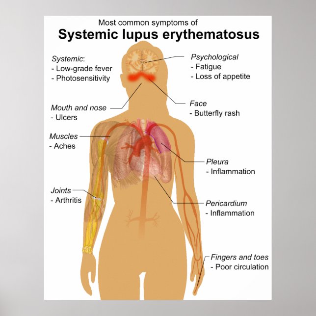 Symptomdiagramm des systemischen Lupus Erythematod Poster (Vorne)
