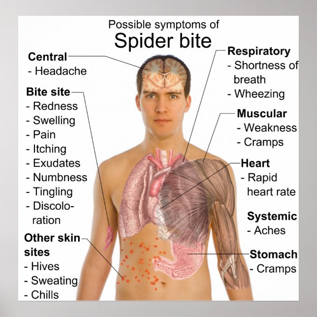 Symptoms Common in Poisonous Spider Bites Chart Poster (Vorne)