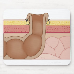 Tapis De Souris Une colostomie permanente