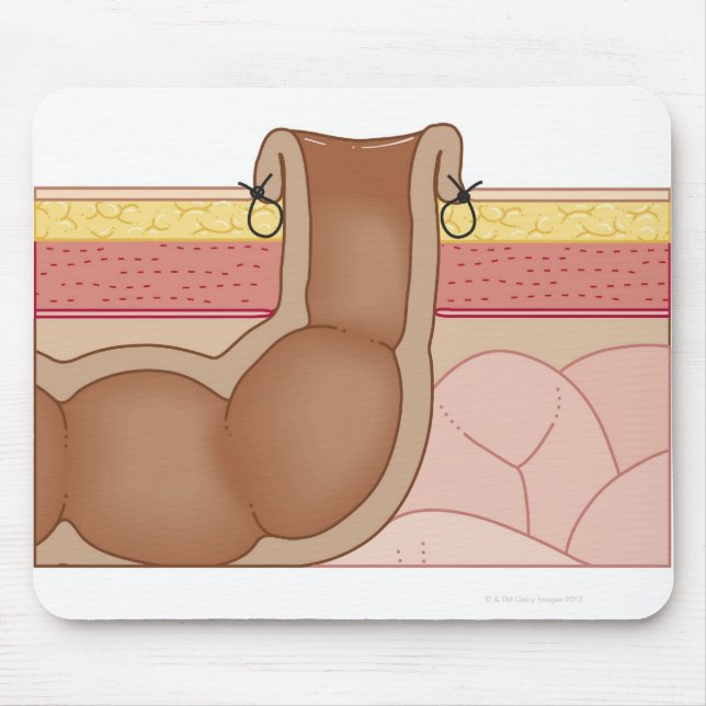 Tapis De Souris Une colostomie permanente (Devant)