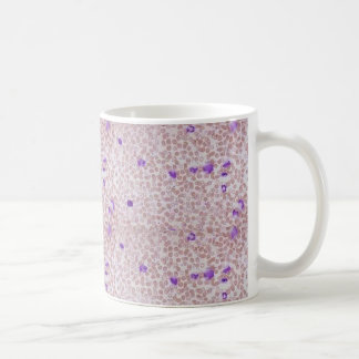 Tasse de café - leucémie myéloïde chronique (CML)